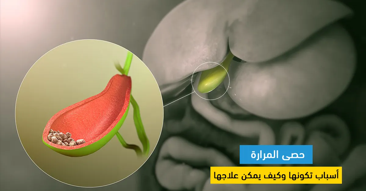 حصى المرارة : أسباب تكونها وكيف يمكن علاجها